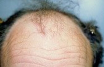 New York Hair Transplant Patient Before