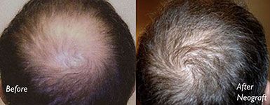 Best Neograft Long Island Before and After Crown Bald Spot