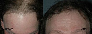 Hair Restoration Before and After