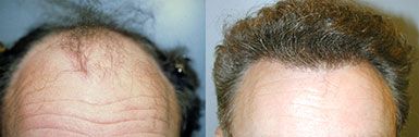 Hair Transplant Before and After