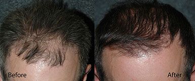 Hair Transplant Follicular Unit Grafting Before and After