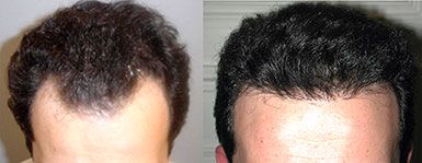 Hair Transplant Long Island Before and After