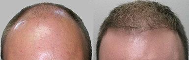 Hair Transplant Neograft Before and After