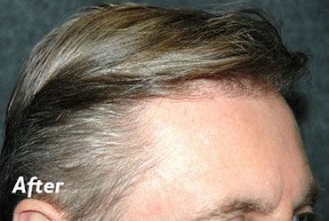 Hair Transplant Long Island After