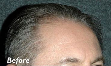 Hair Transplant Long Island Before