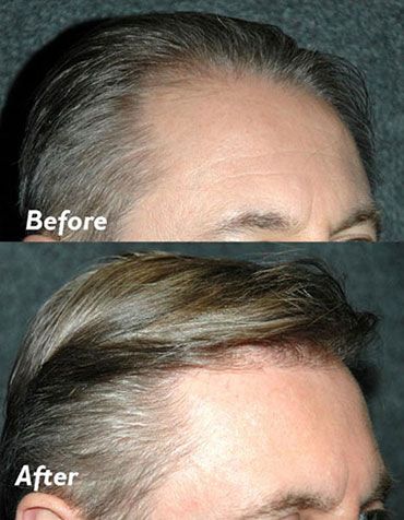 Hair Transplant Long Island Before and After