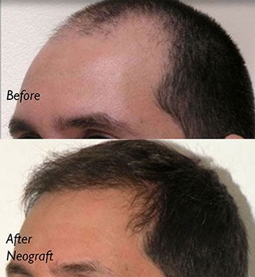 Neograft Long Island Before and After Receding Hairline Patient
