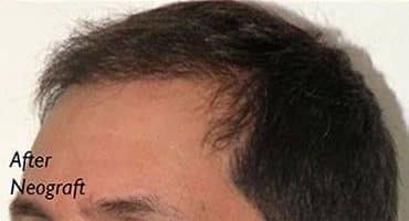 Neograft Long Island After Receding Hairline Patient