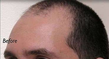 Neograft Long Island Before Receding Hairline Patient