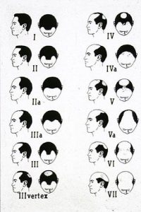 progression of hair loss