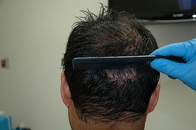 New York Follicular Unit Grafting Donor Site Closed