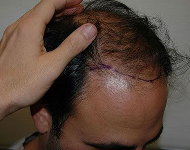 Frontal-Hairline-Marking