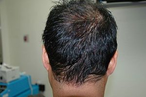 New York Hair Transplant Before and After