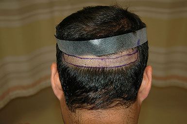 New York Hair Transplant Thin Strip