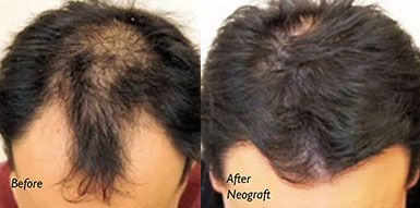 Neograft New York Before and After