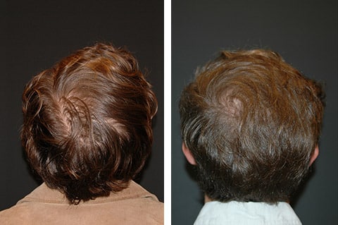 PRP Patient Before and After