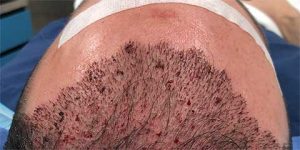 neograft hair transplant patient before after photo