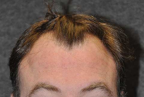 hairline transplant patient before photo