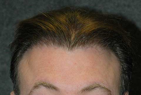 hairline transplant patient after photo