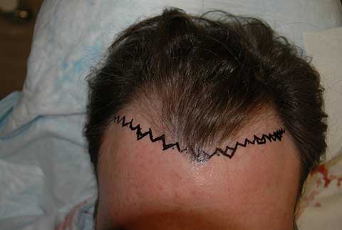 hairline transplant patient marking before photo