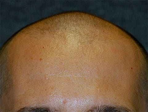 hair restoration patient before photo