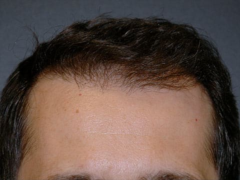 hair restoration patient after photo