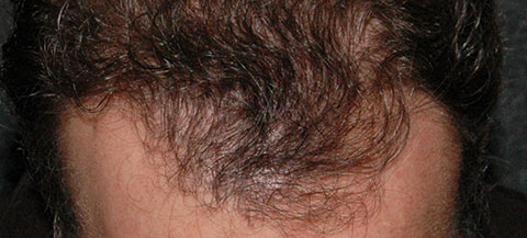 hair rejuvenation patient before photo