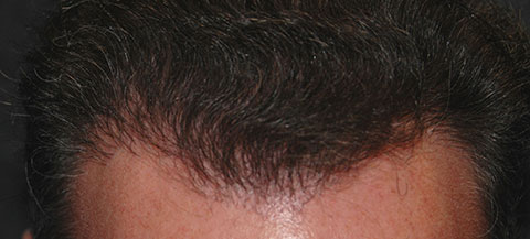 hair rejuvenation patient after photo