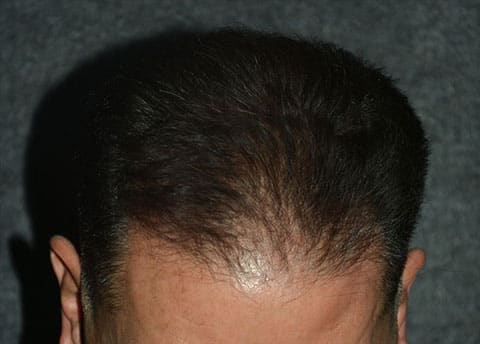 hair transplantation patient before photo