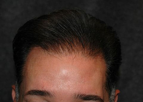 hair transplantation patient after photo