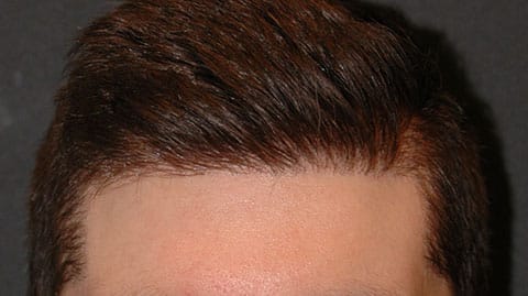 hair transplant after