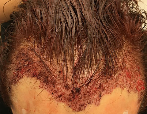 hairline hair transplant after photo