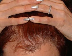 hair restoration after plastic surgery before