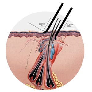 Follicular Extraction - WAW FUE NYC