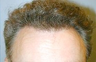 New York Hair Transplant Patient After