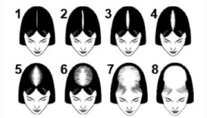 Female Pattern Baldness